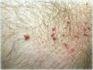 Skin Tag