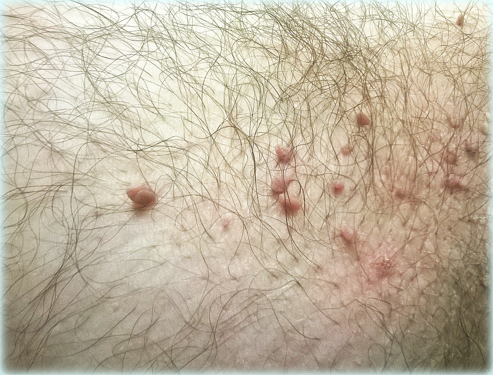 Skin Tag & Acne Removal Patches