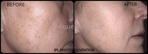 IPL Photorejuvenation