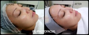 IPL Photofacial