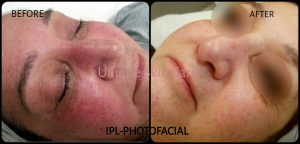 IPL-Photofacial