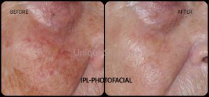 IPL_Photofacial