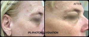 IPL Photorejuvenation