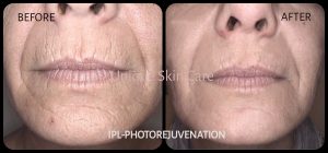 IPL Photorejuvenation