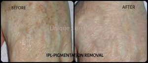 IPL Pigmentation Removal