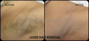 Laser Hair Removal