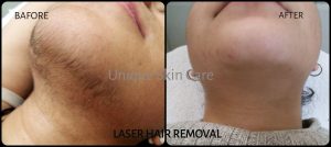 Laser Hair Removal