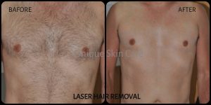 Laser Hair Removal