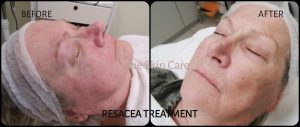 Rosacea Treatment