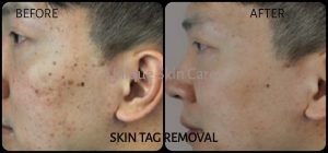 Skin Tag Removal